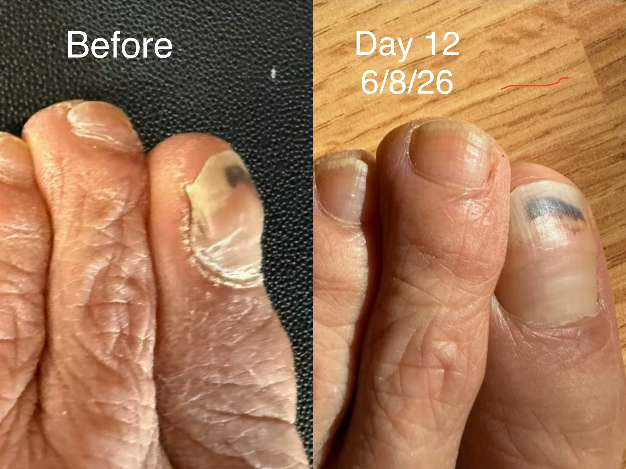 TOE BEFORE AND AFTER J:8:26.jpg