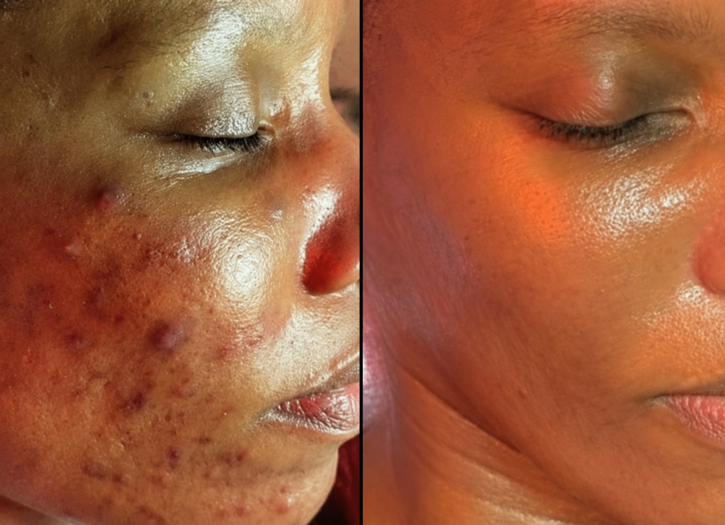 complexion code offers programs to remove hyperpigmentation and dark spots.  if you are lookin for a black esthetician who specializes in melated skin with over 15 years experience