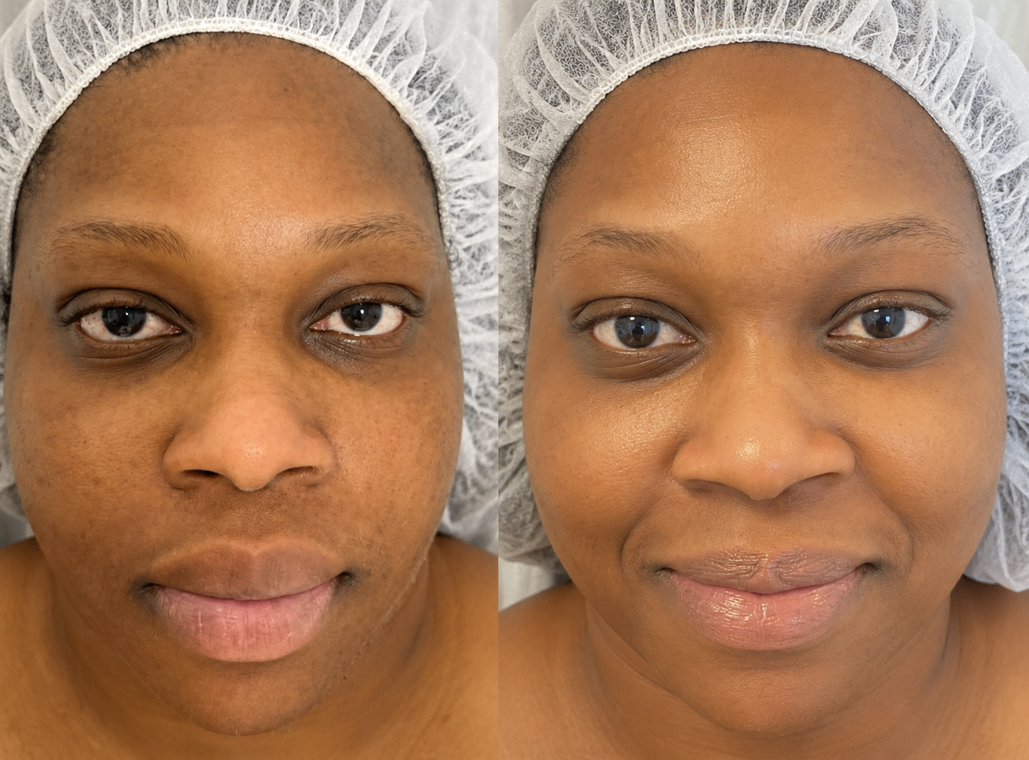 Side-by-side comparison of a woman's face before and after skincare treatment, showing clearer, more even skin tone on the right. complexion code atlanta, ga