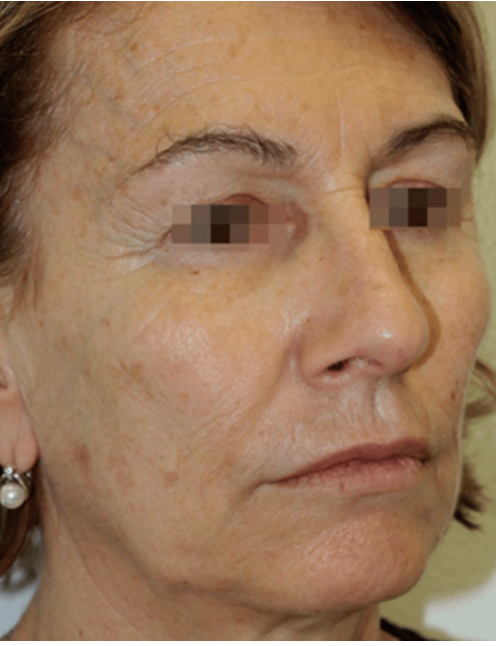 Profhilo - After 1 Treatment