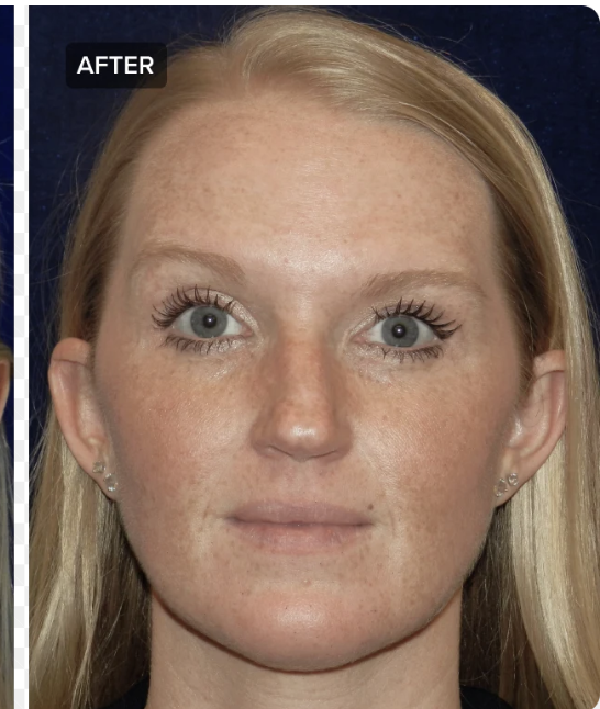 After - 1 Session of Anti-Wrinkle Injections