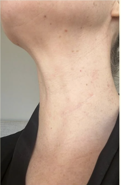 After - Microneedling 2 Sessions