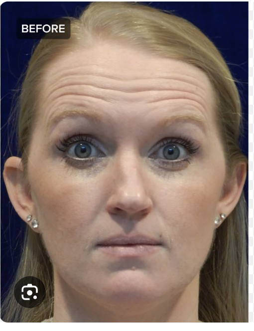 Before - Anti-Wrinkle Injections