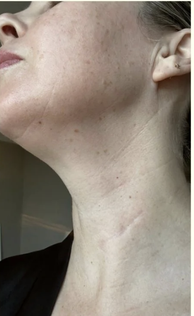 Before - Microneedling