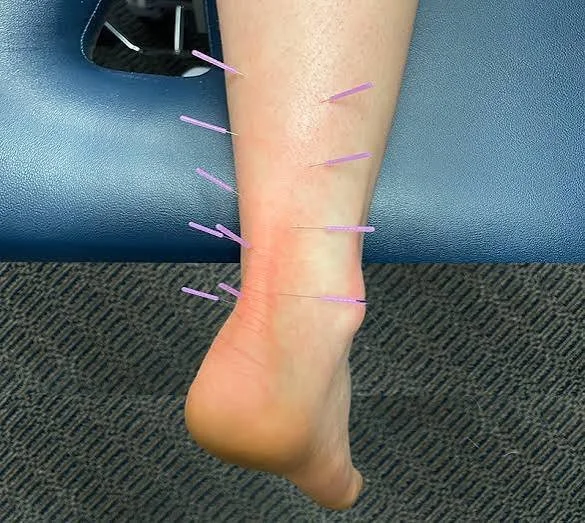 A foot with several acupuncture needles inserted along the ankle and lower leg.