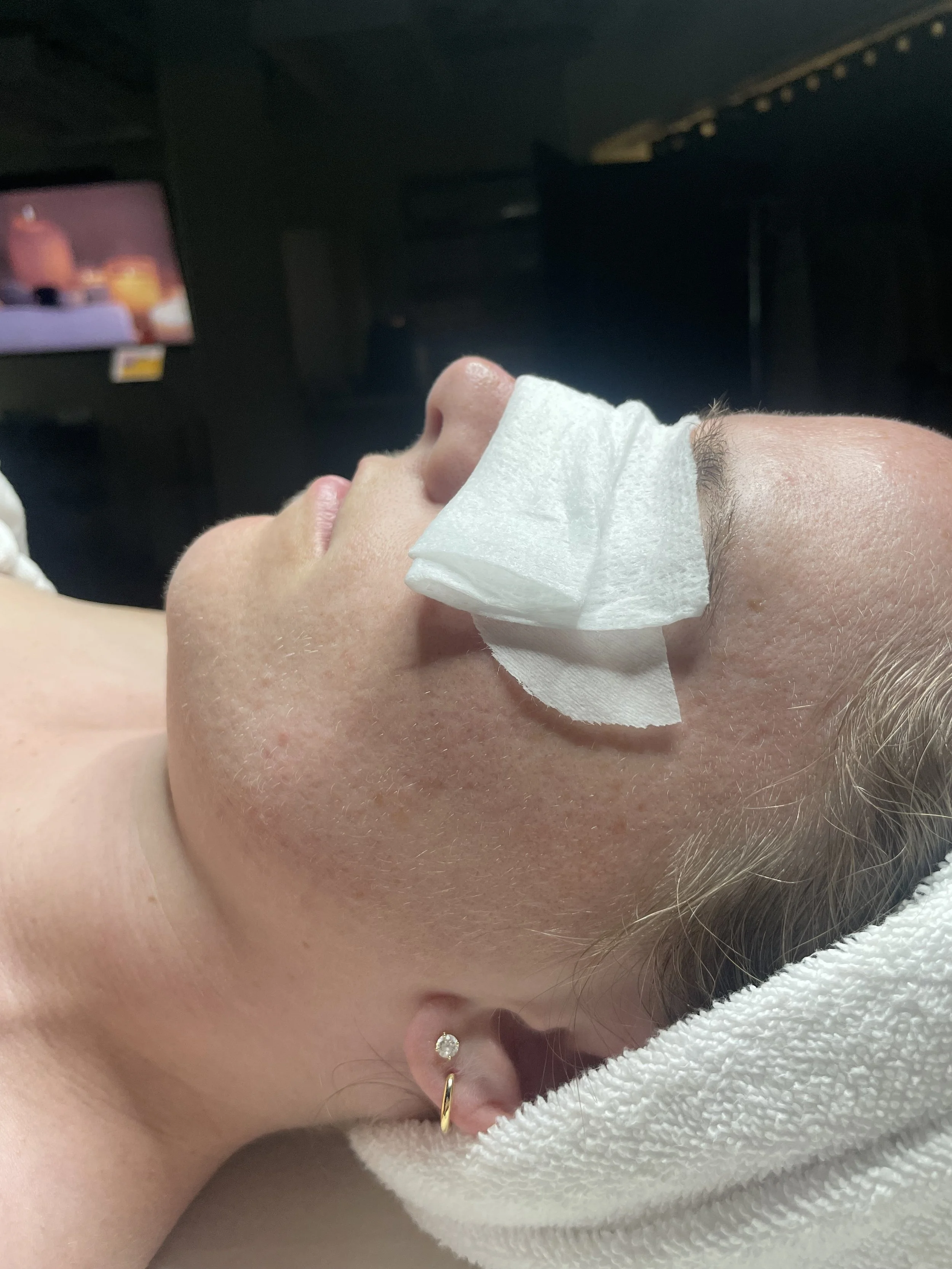 DERMAPLANE (BEFORE)