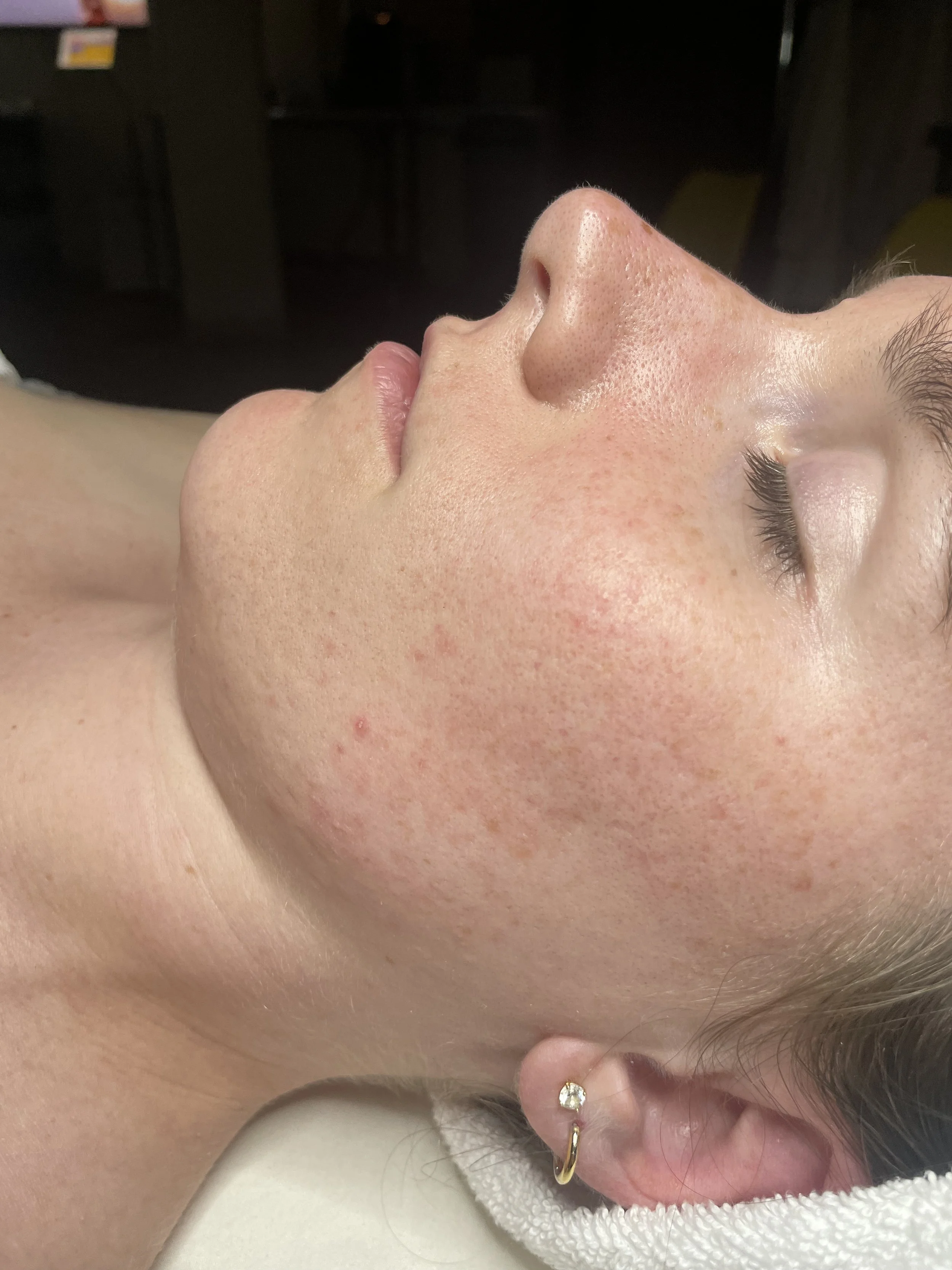 DERMAPLANE (AFTER)