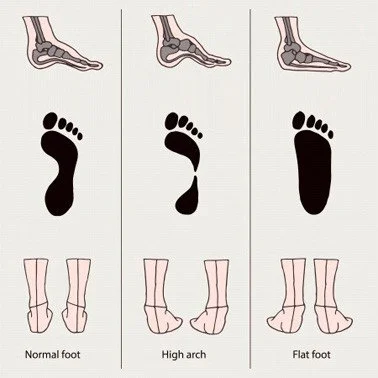 Flat Foot/Cavus Foot