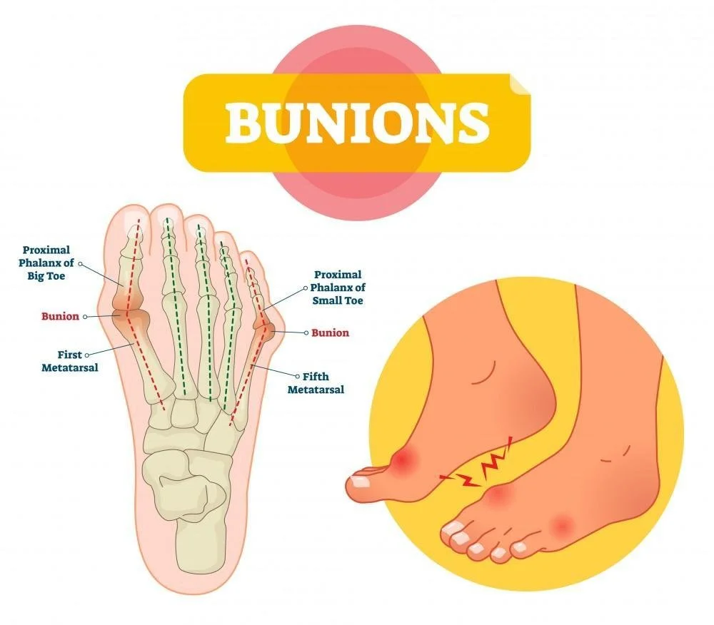 Bunions