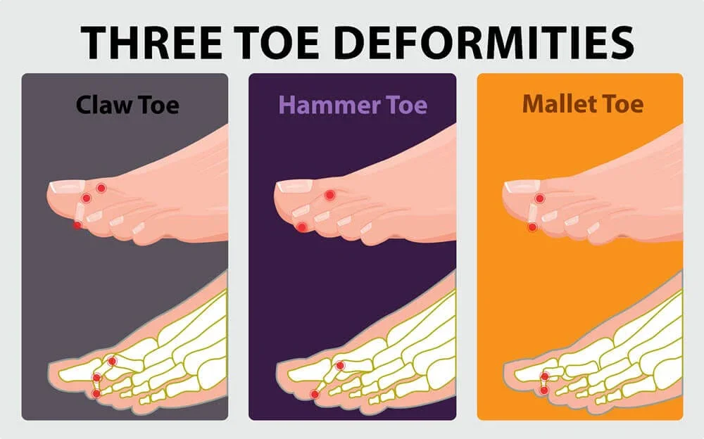 Hammer toe