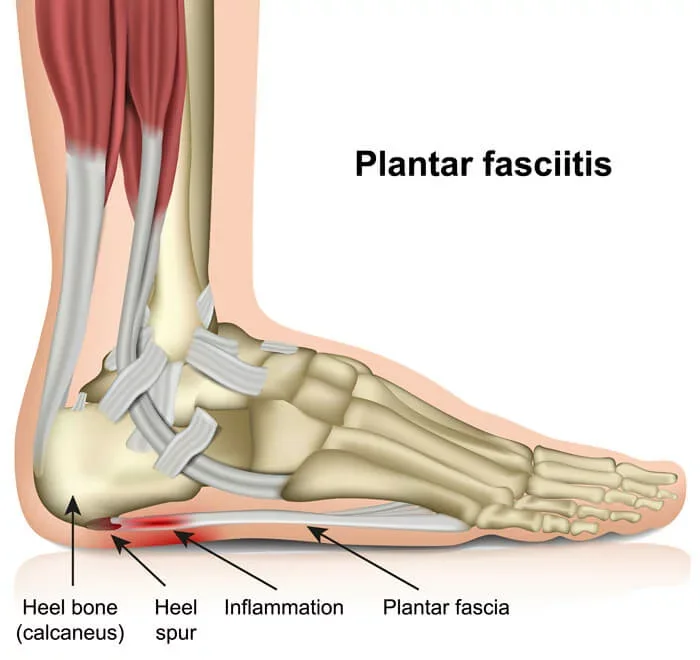 Plantar Fasciitis