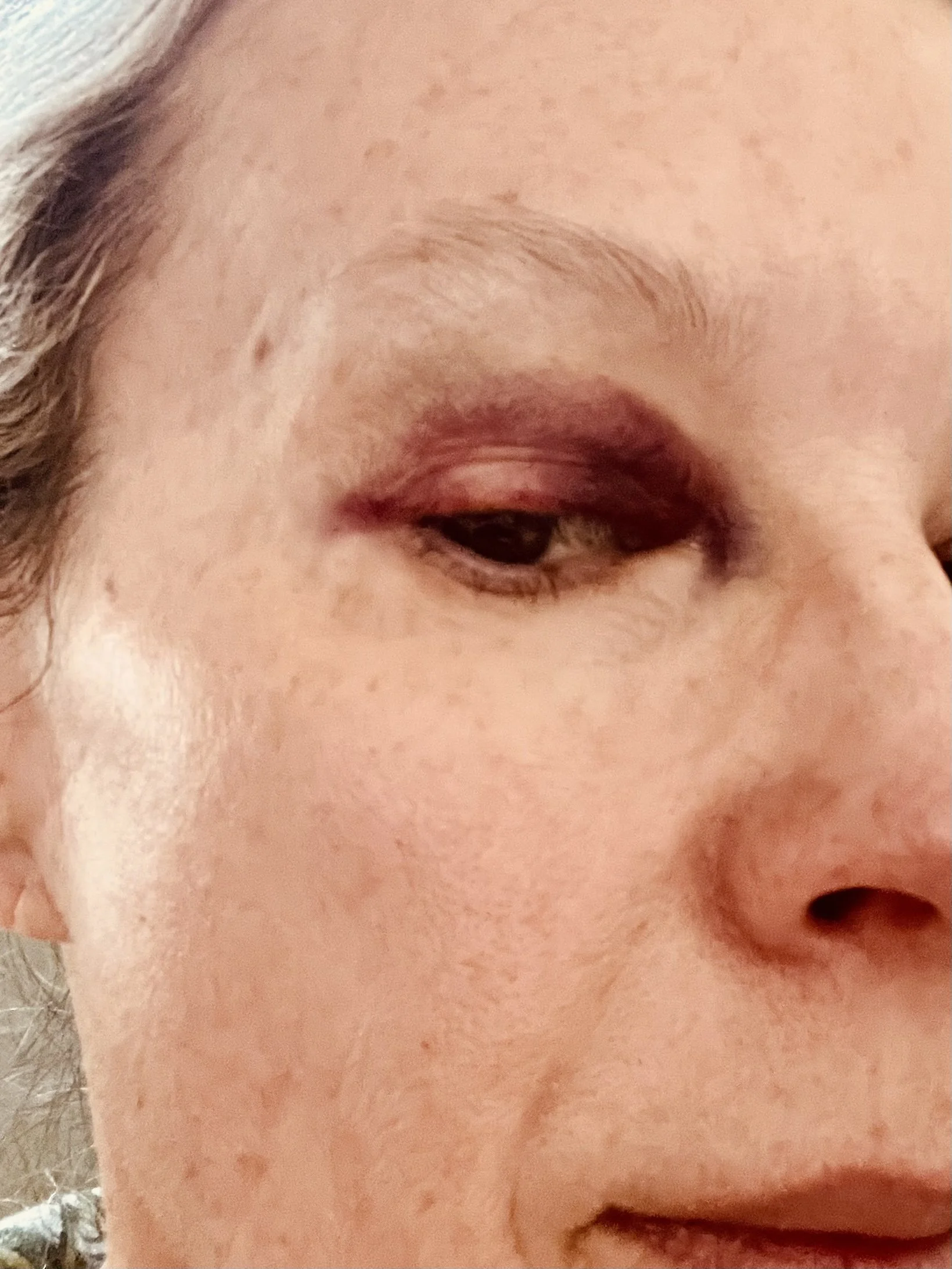 black eye.jpg