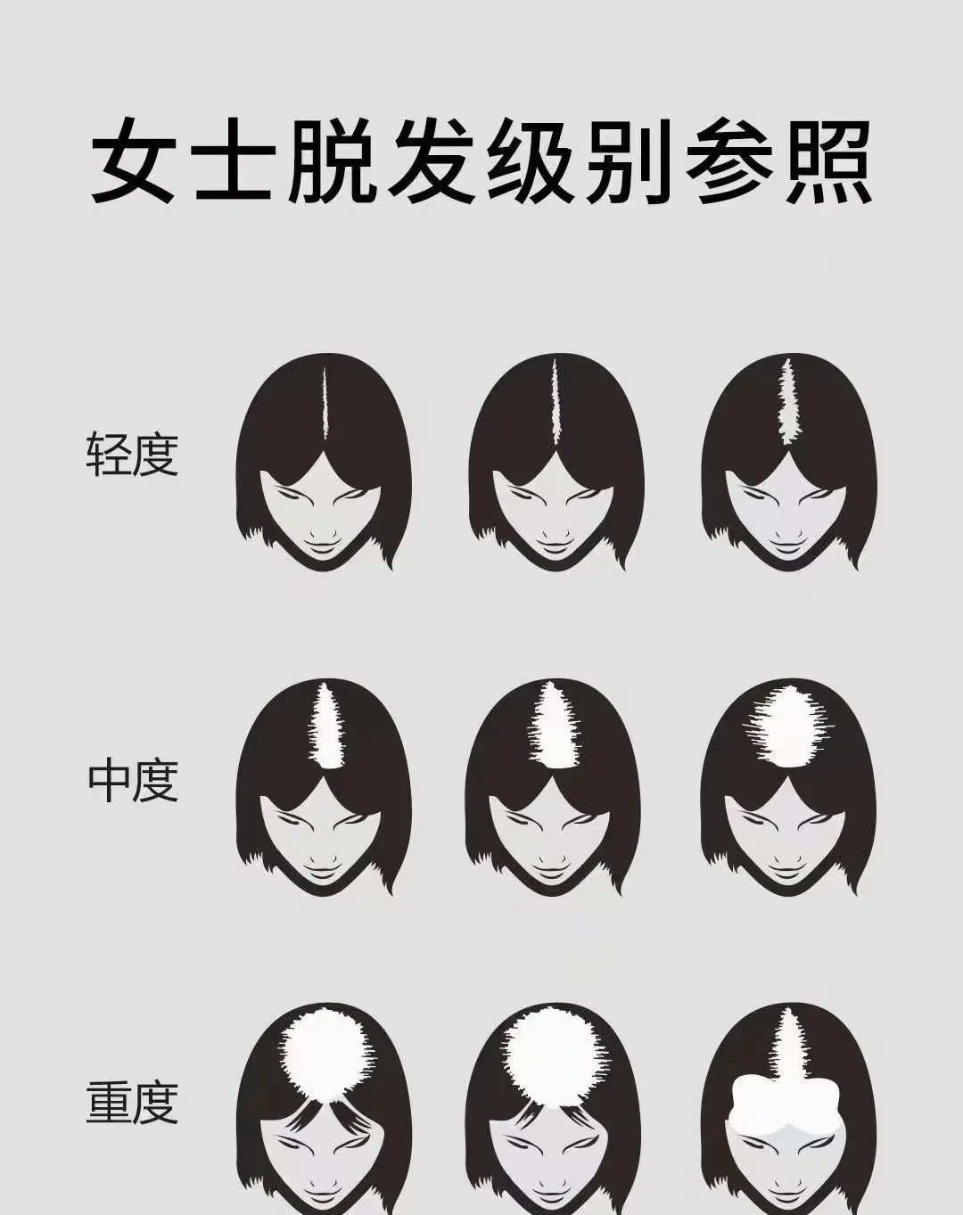 Hair loss stages and scalp micropigmentation (hair tattoo) treatment options for men and women
