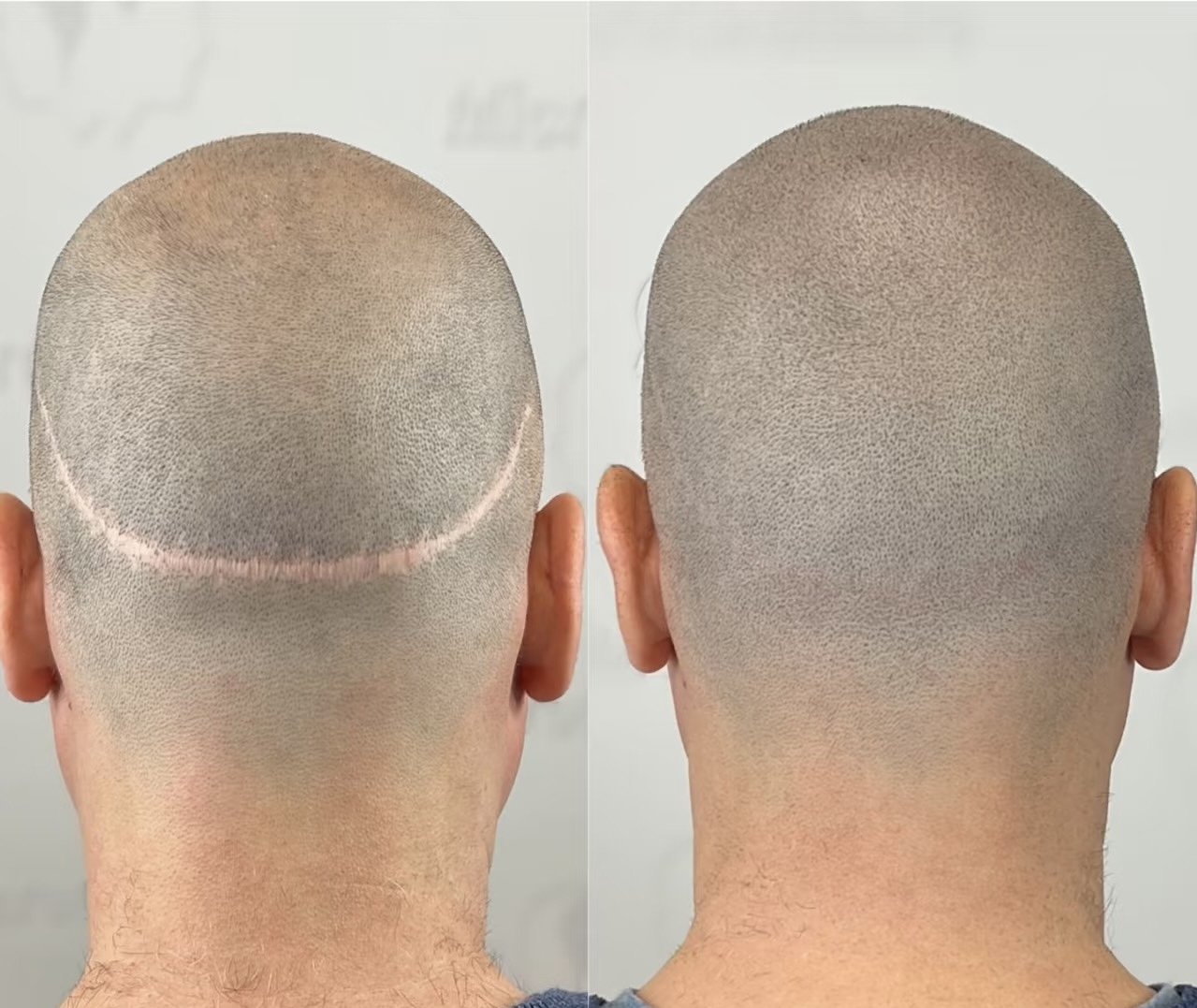 Hair loss (Alopeicia) before and after result with FUT/FUE camouflage