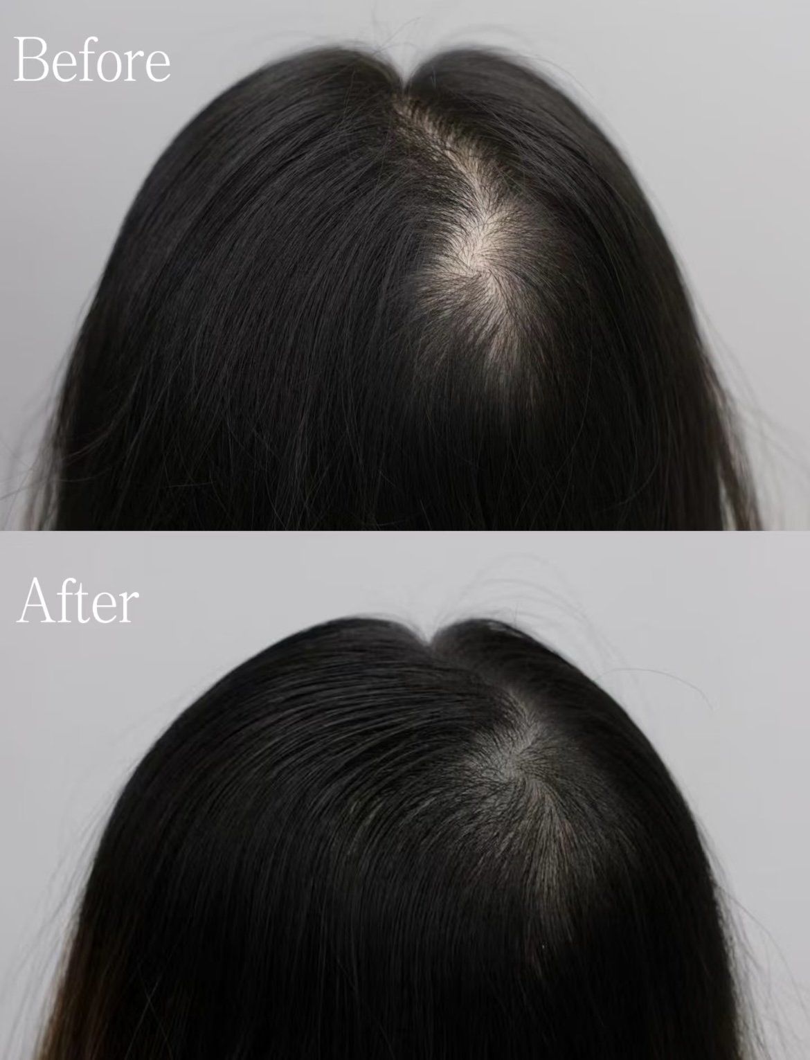 Hair density restoration for  thinning hair