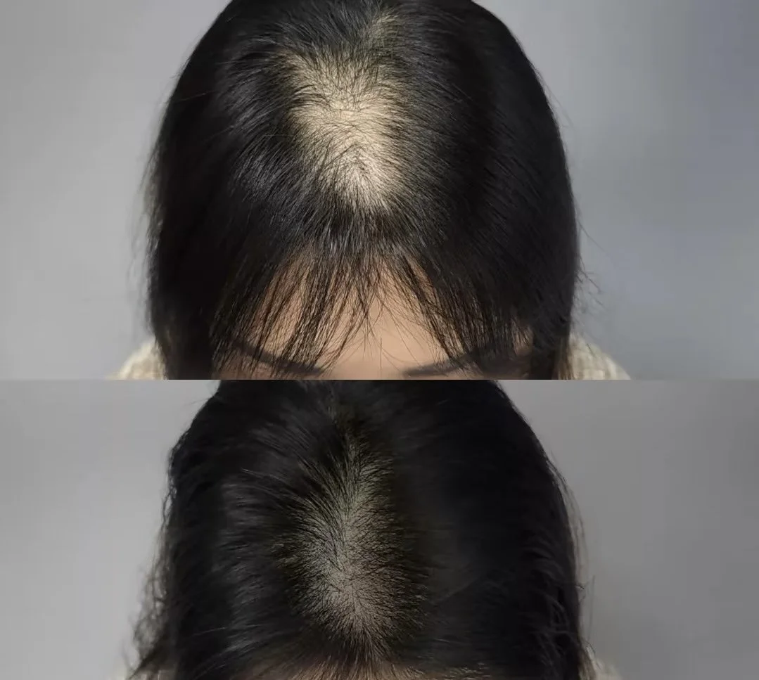Comparison of top views of a person's head showing hair thinning before and after treatment with hair tattoo technique