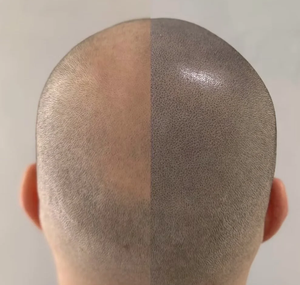 Hair tattoo before and after for thinning hair and natural scalp density