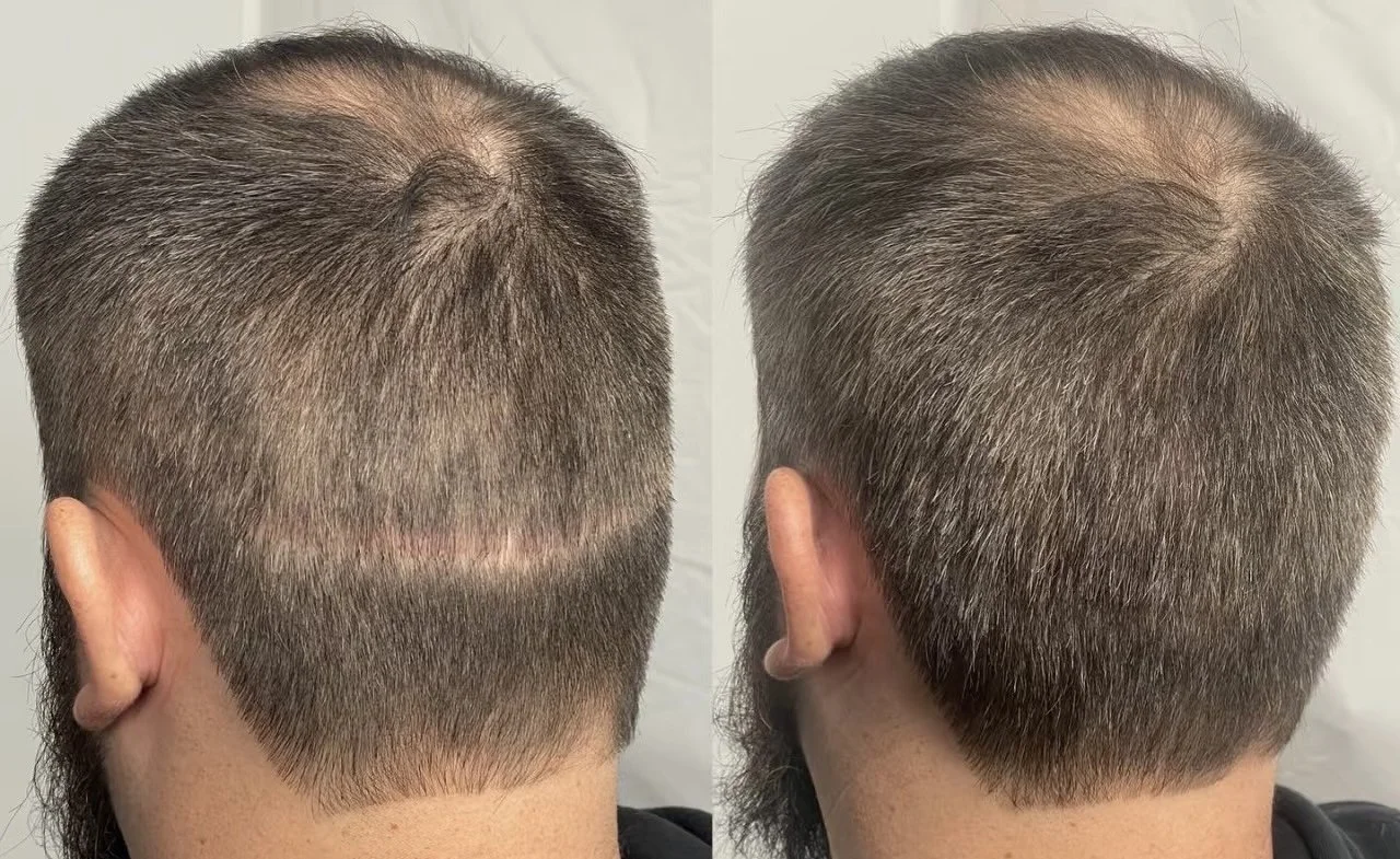 Hair transplant failure with SMP camouflage results