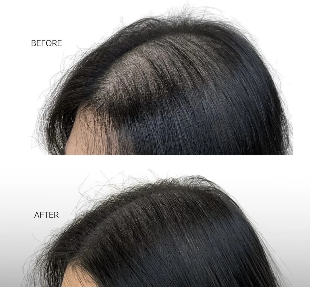 Hair tattoo for thinning hair creating natural scalp coverage and density