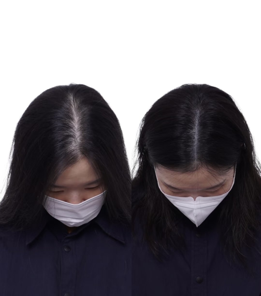 Scalp Micropigmentation for women with thinning hair and wider part lines.