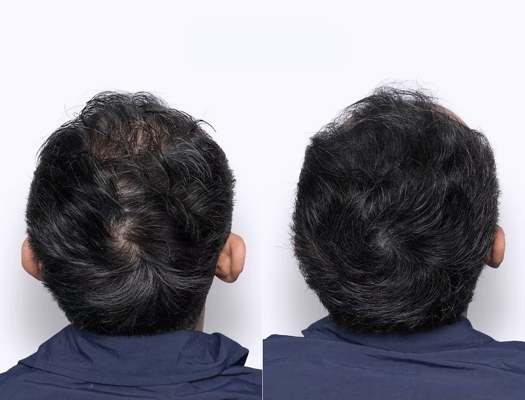 Scalp Micropigmentation ( Hair Tattoo) for thinning hair with natural density results