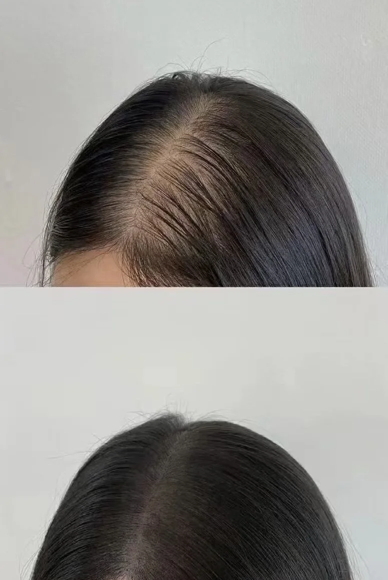 Hair density for women thinning hair with scalp micropigmentation (SMP)