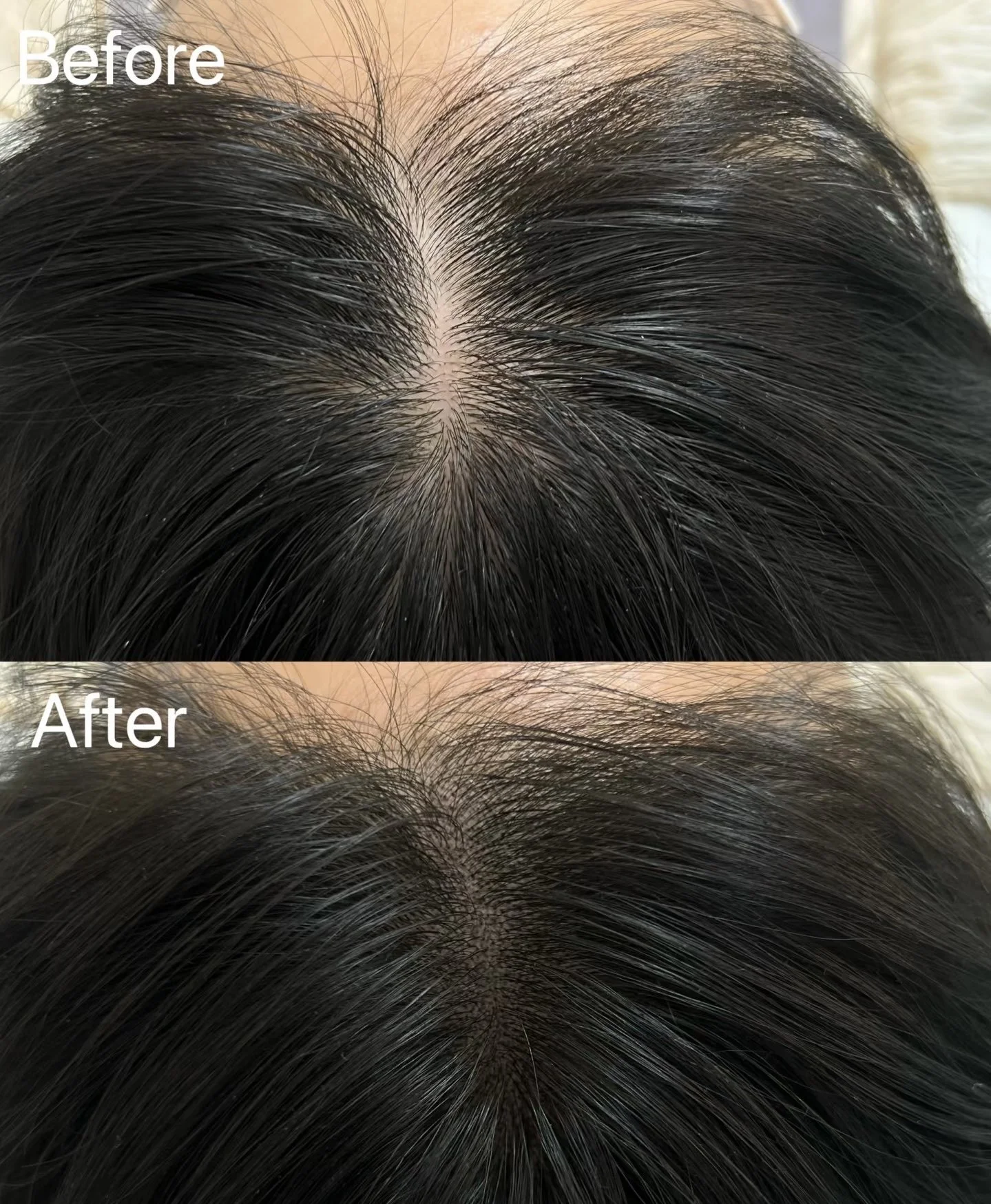 Scalp Micropigmentation (Hair Tattoo) creading hair density for thinning hair