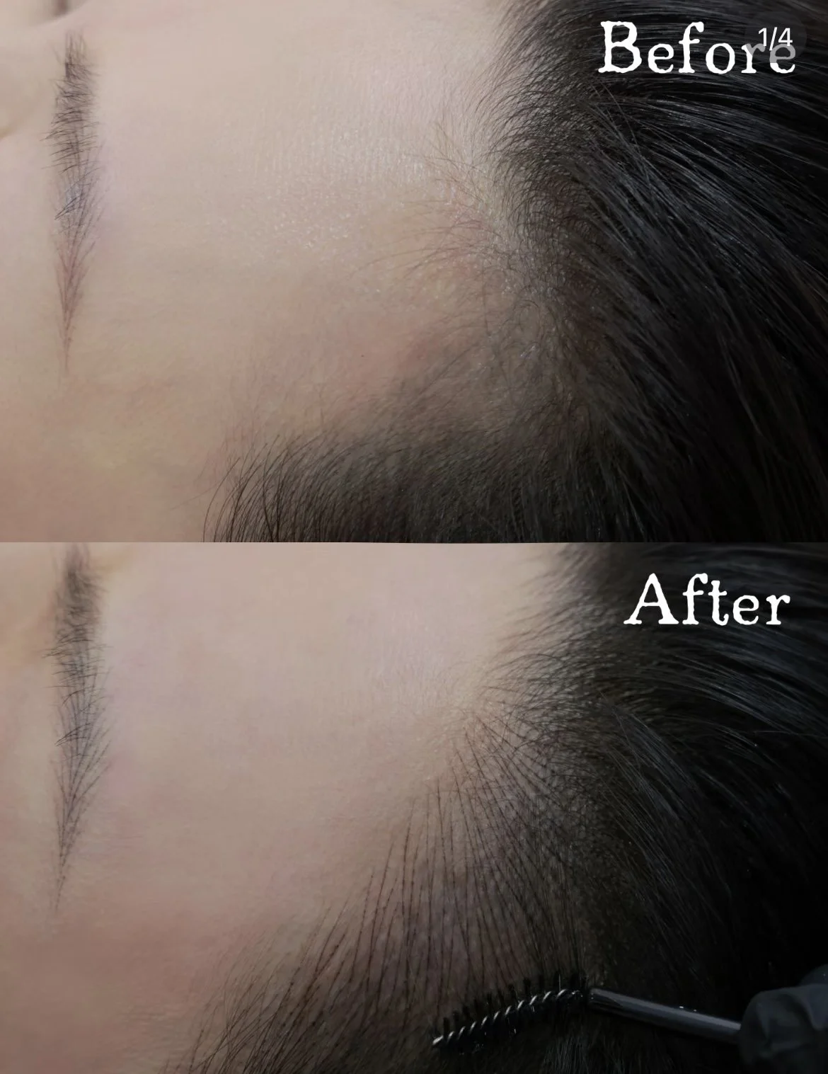 Hairline restoration with nano strokes SMP technique