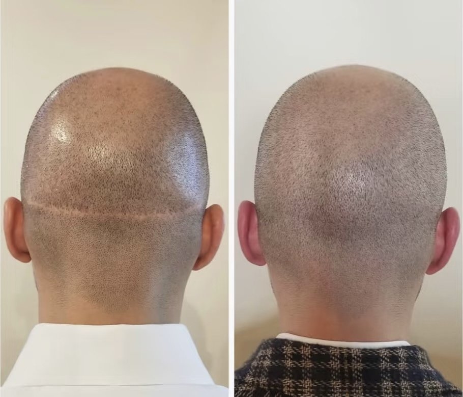 Hair tattoo before and after for crown hair loss using scalp micropigmentation (SMP after FUT)