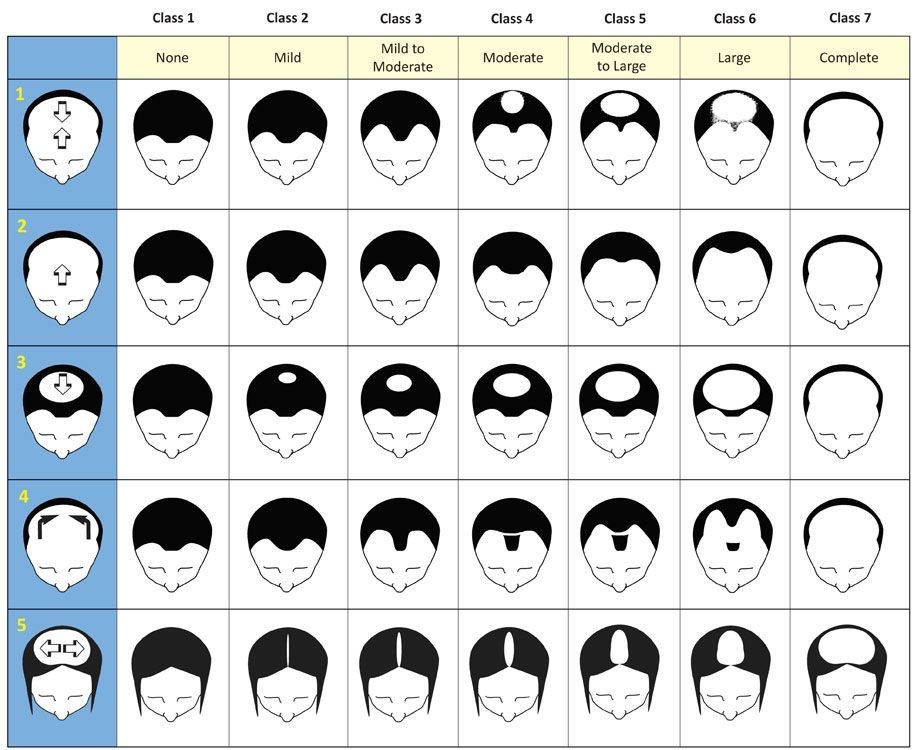 Hair loss stages suitable for scalp micropigmentation (hair tattoo types)