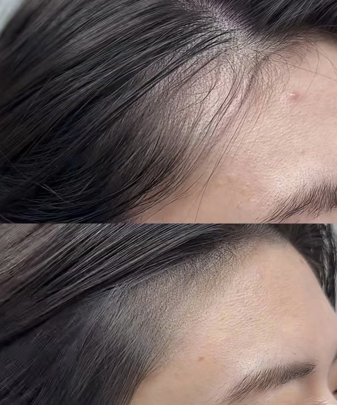 Hairline restoration with Scalp Micropigmentation for a natural-looking hairline