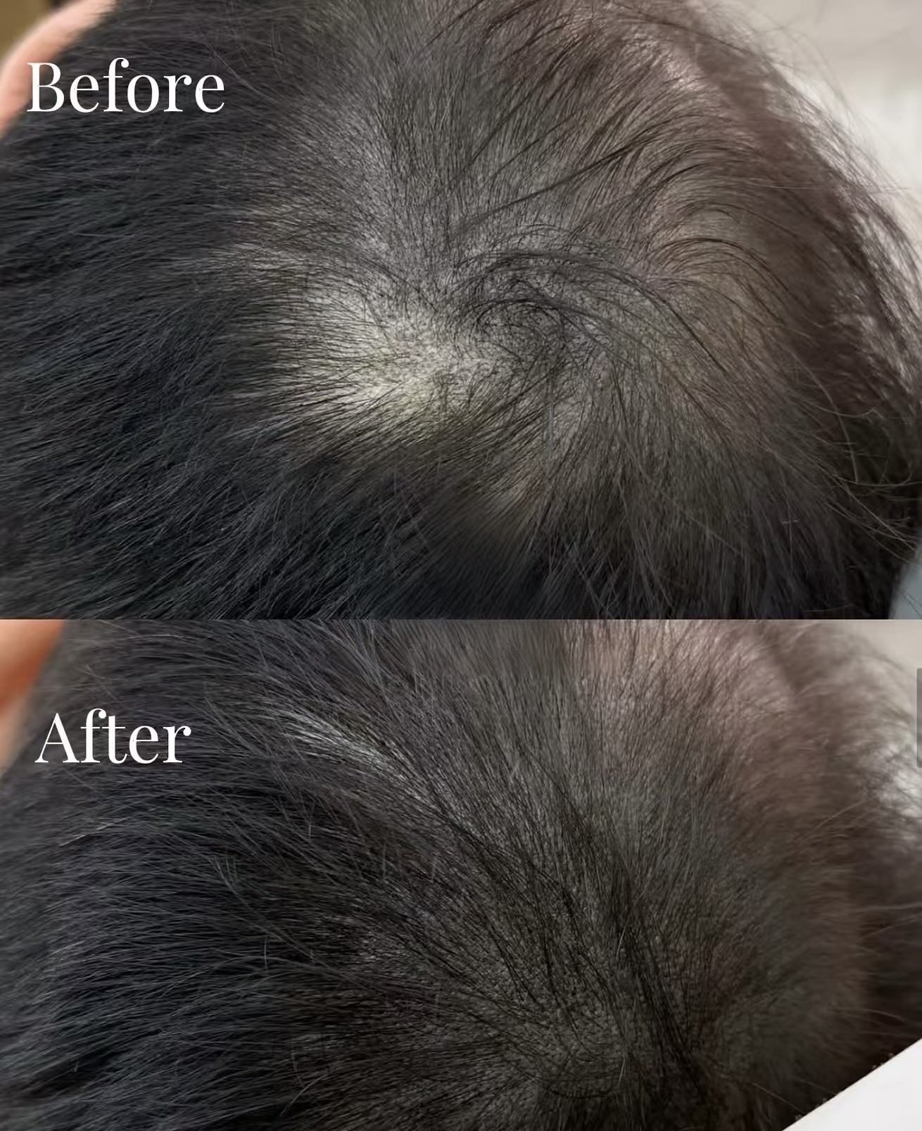 Hair tattoo before and after for men’s thinning hair and wider hair part using Scalp Micropigmentation (SMP)