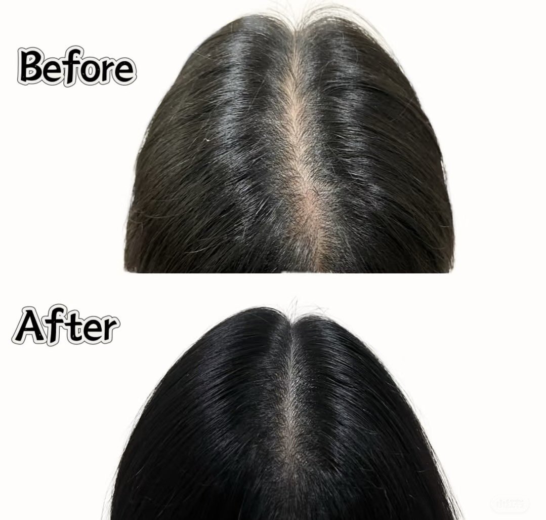 Hair tattoo treatment improving the appearance of thinning hair with natural scalp density