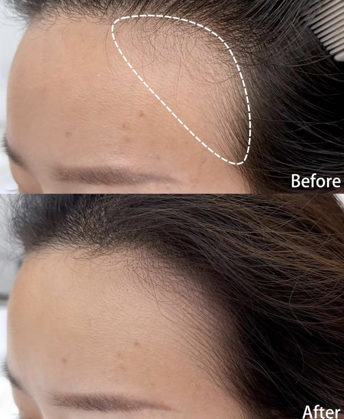 Women hairline restoration with hair strokes tattooing techniques