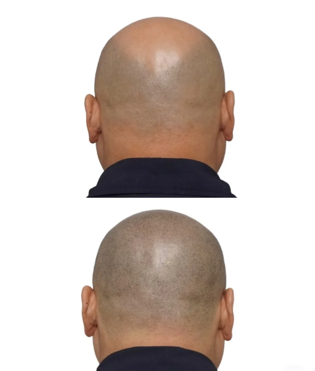 Scalp micropigmentation ( hair tattoo) for crown hair loss with natural looking results