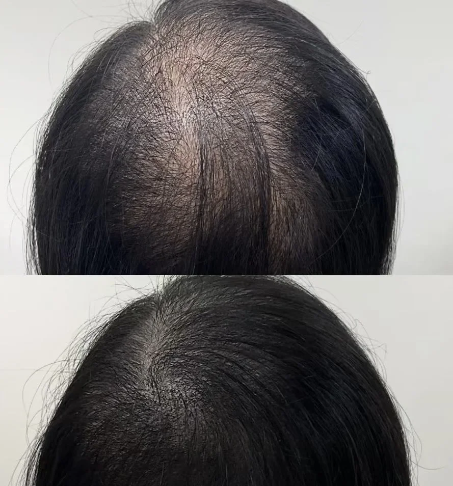 Hair density tattoo before anda fter for thinning hair and bald spots