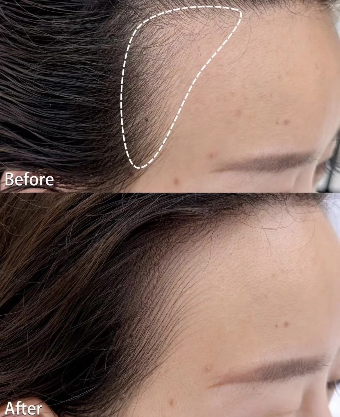 Women SMP with hair line restoration