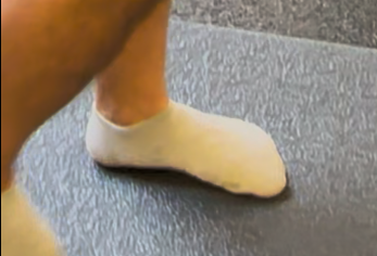 What was a flat foot; now has an actively engaged arch while walking without surgery and no orthotics