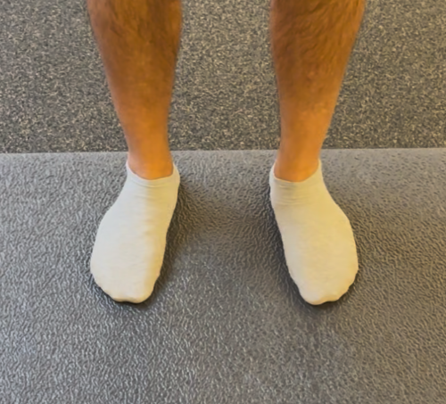 Flat feet before doing the foot program to fix posture of the foot.