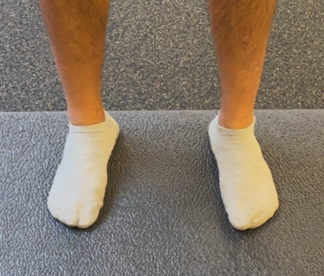 Flat footed person now with an arch due to now having proper foot pressure, fixing flat feet naturally