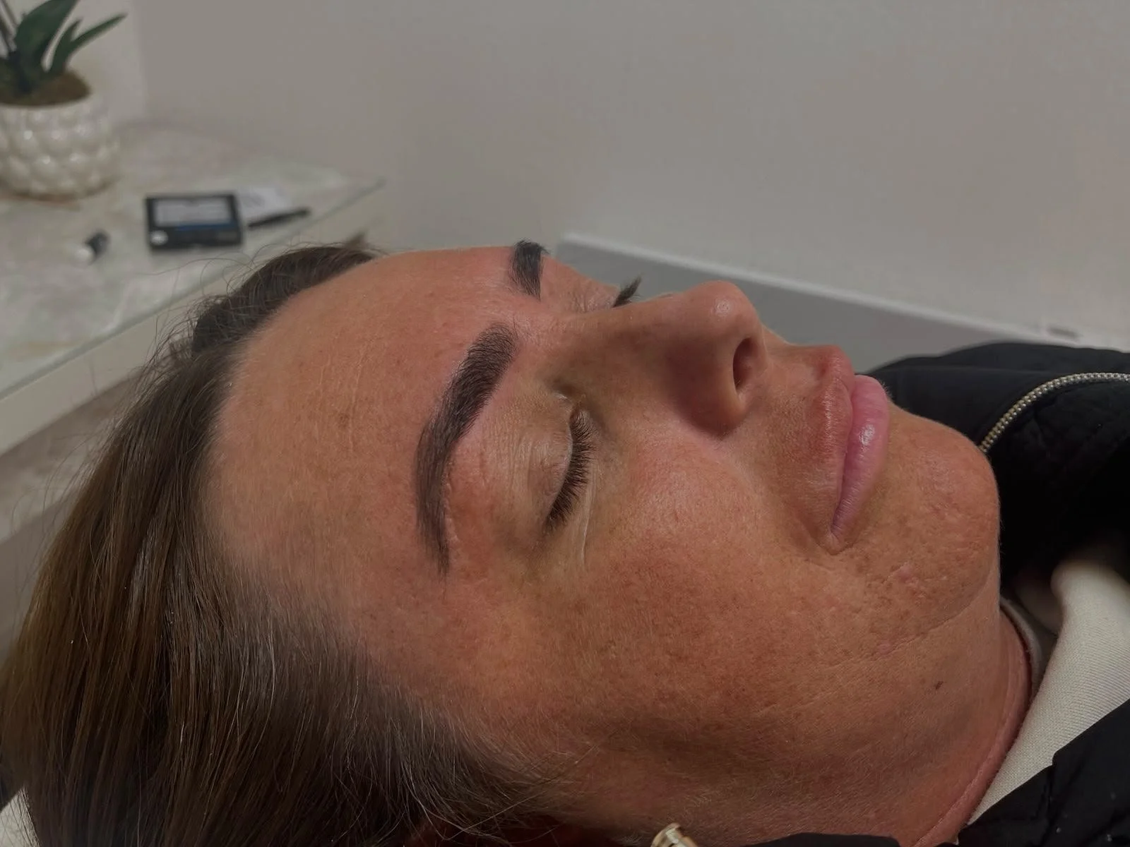 A woman with freshly stitched eyebrows resting with her eyes closed.