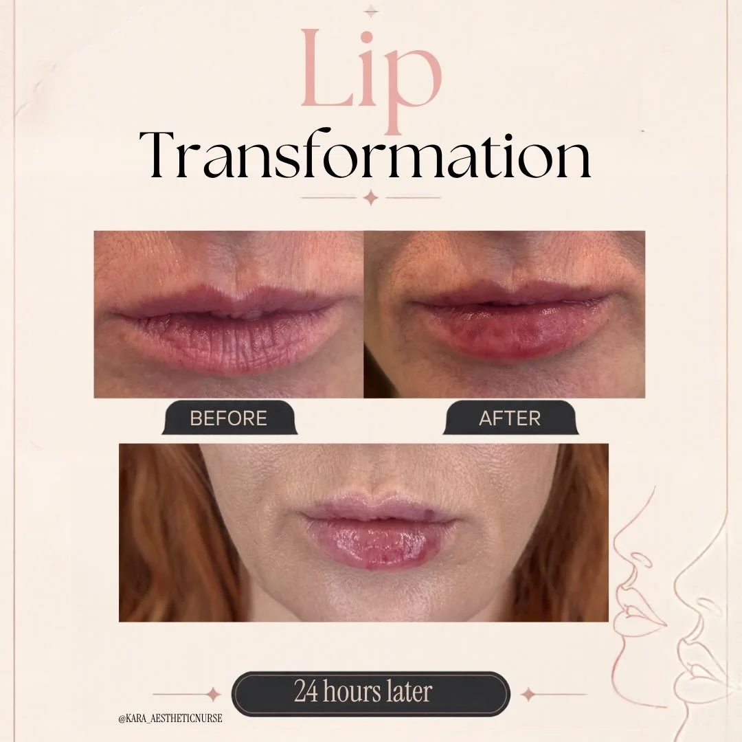 💋 Lip filler + swelling &amp; bruising = part of the process! This is my recent lip journey. 

Swelling, tenderness, and bruising are completely normal after lip filler and can vary from person to person. Your lips may look uneven or feel a little d