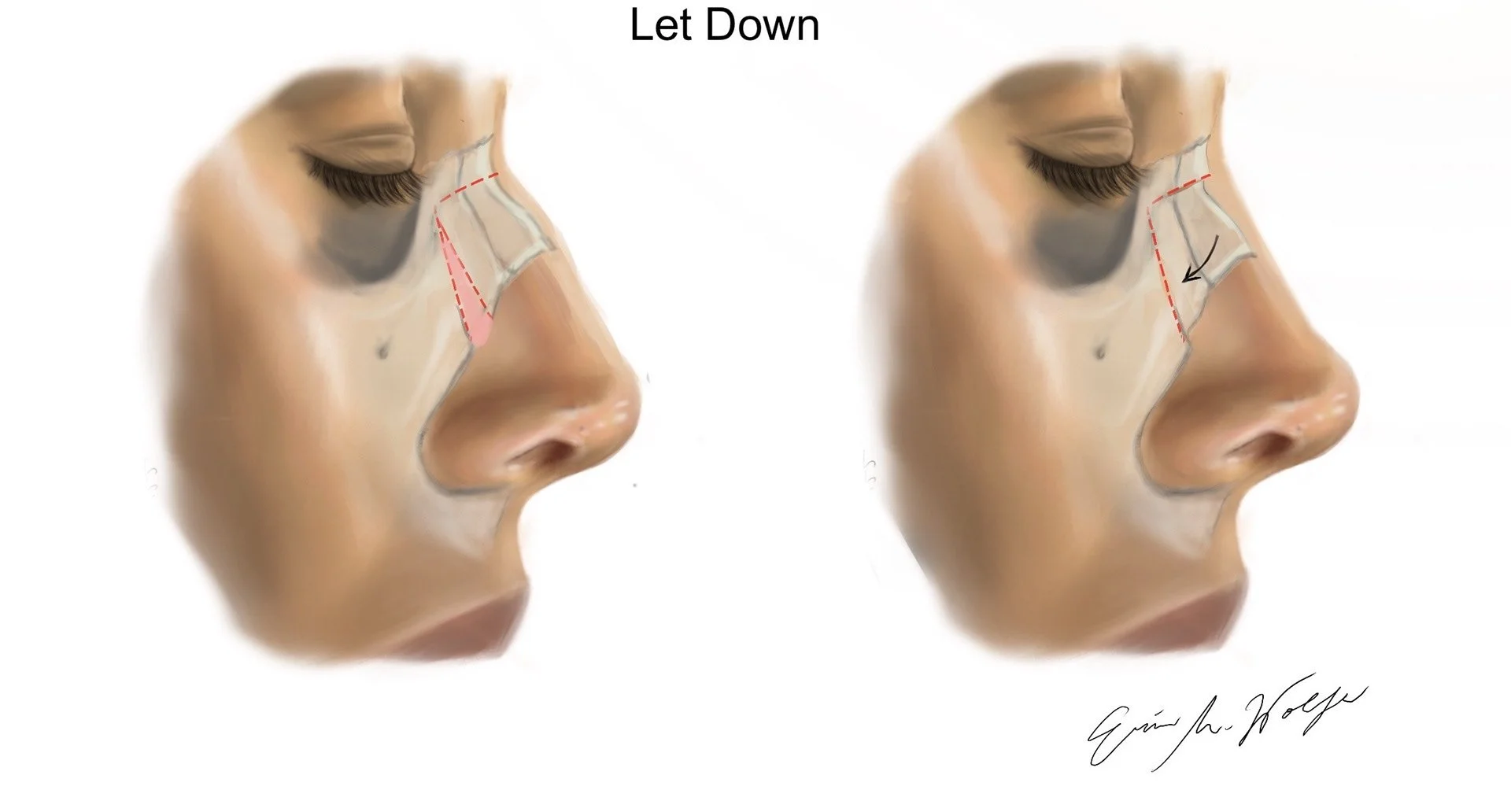 Preservation Rhinoplasty