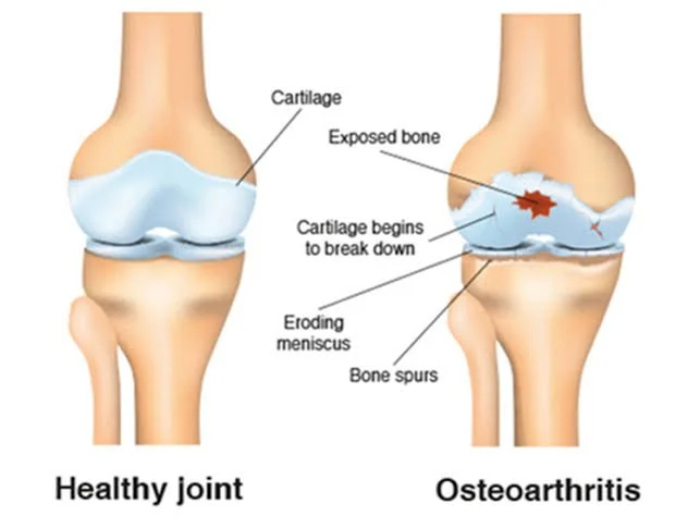 Image of knee joint bones showing osteoarthritic degenration
