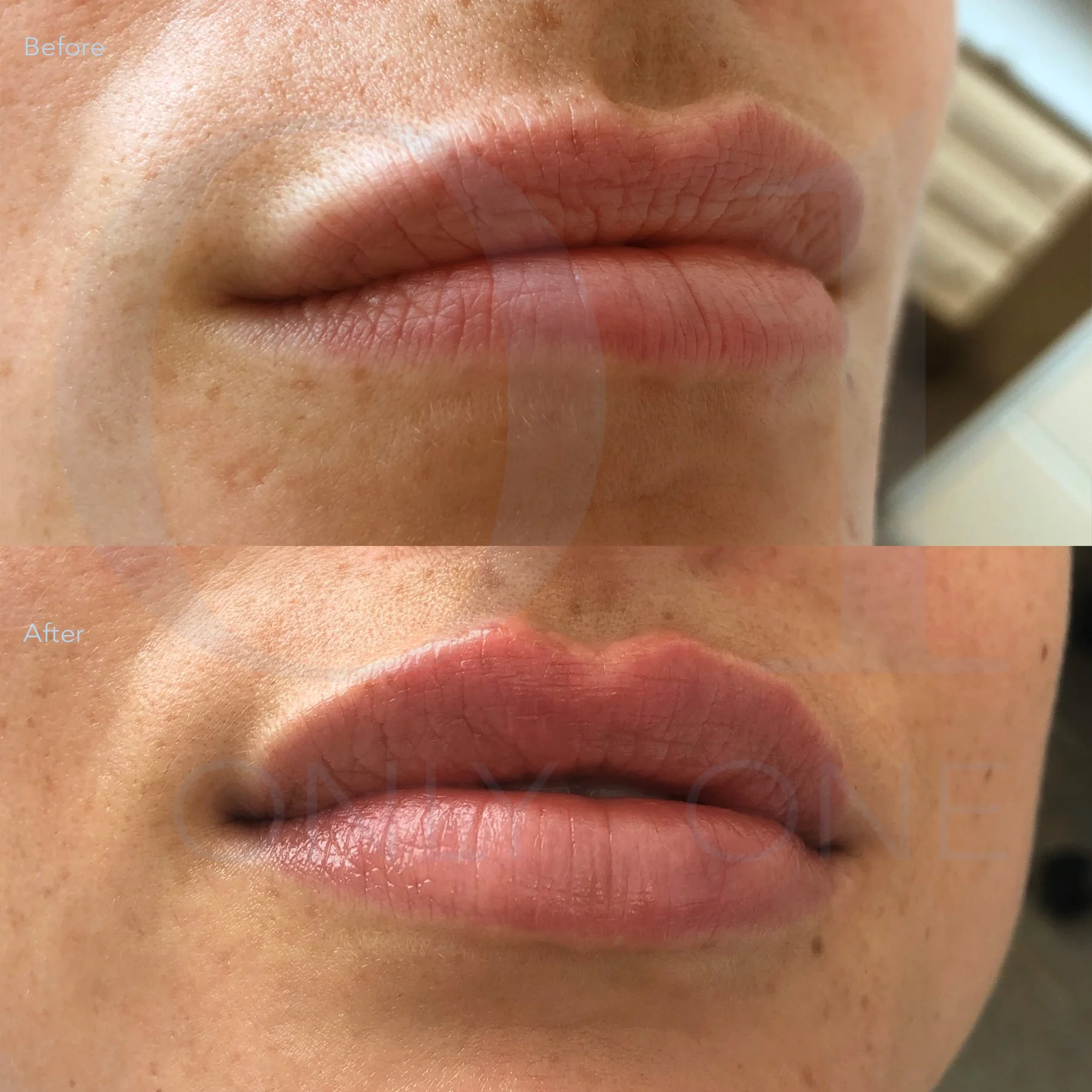 Restylane lip filler, single session