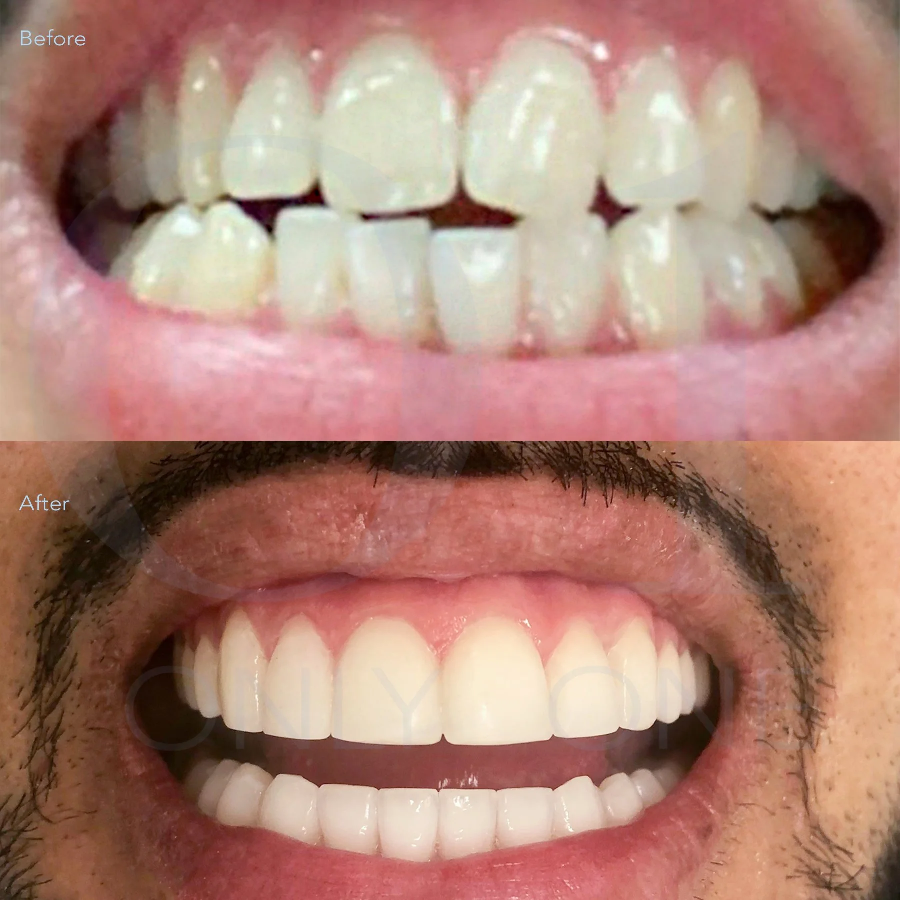 Invisalign, 8 Composite bondings