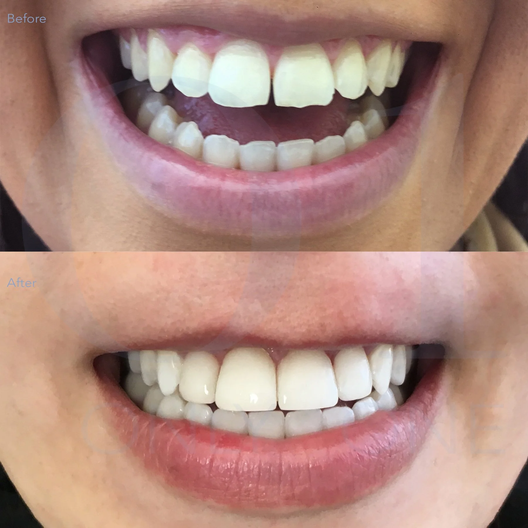 Composite bonding, 4 upper teeth