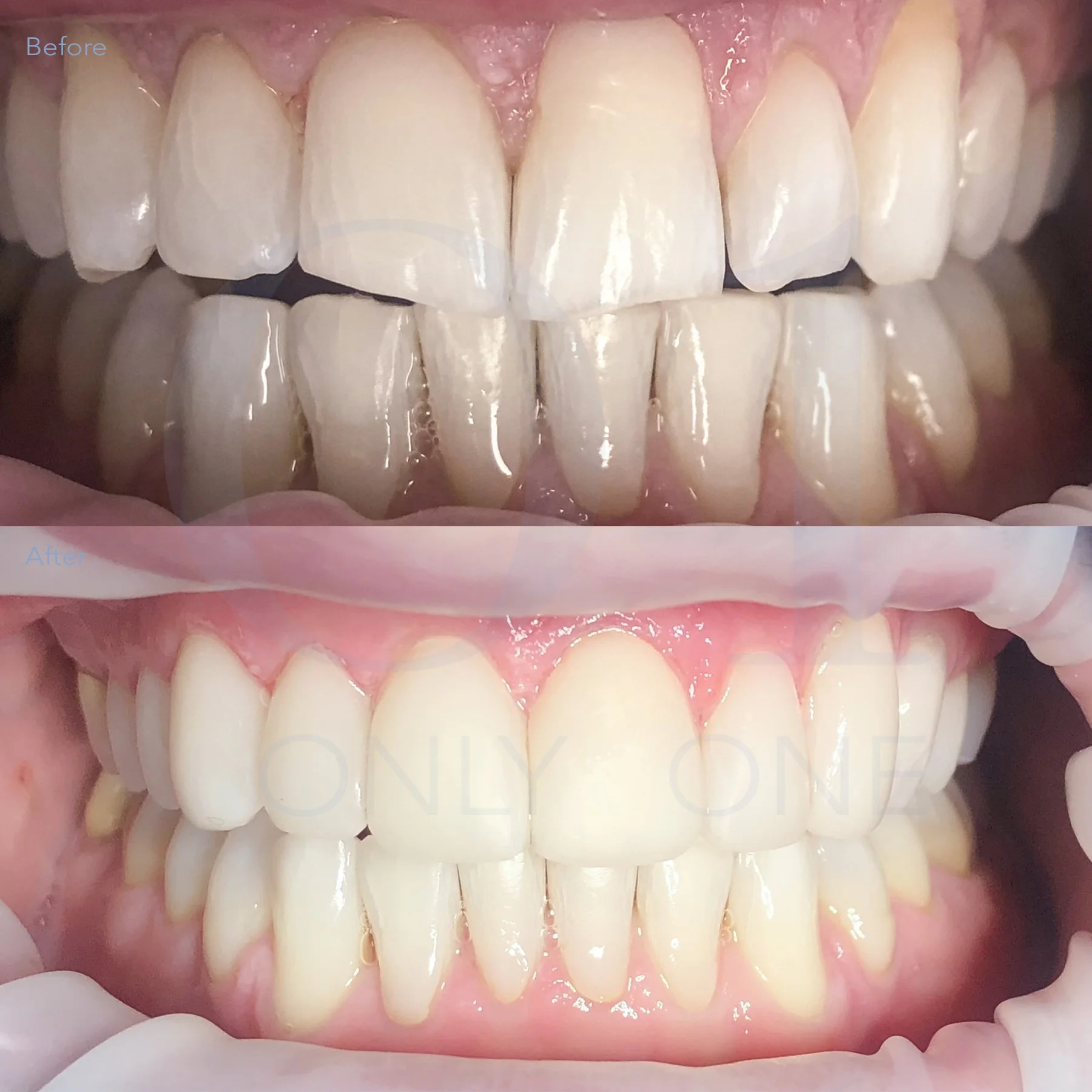 Teeth whitening, composite bonding, 6 upper teeth
