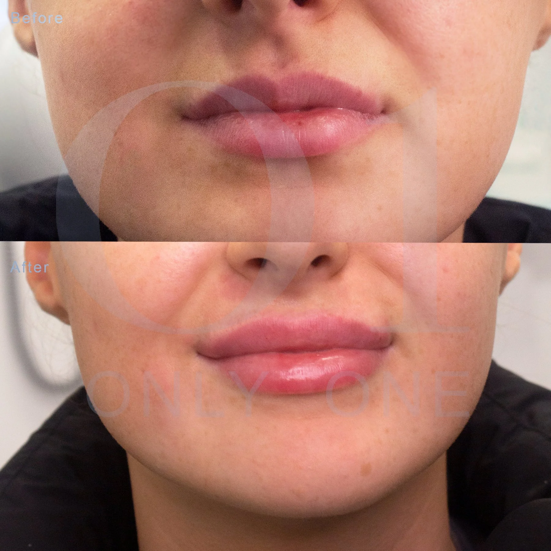 Restylane lip filler, single session and Polynucleotide, single session 
