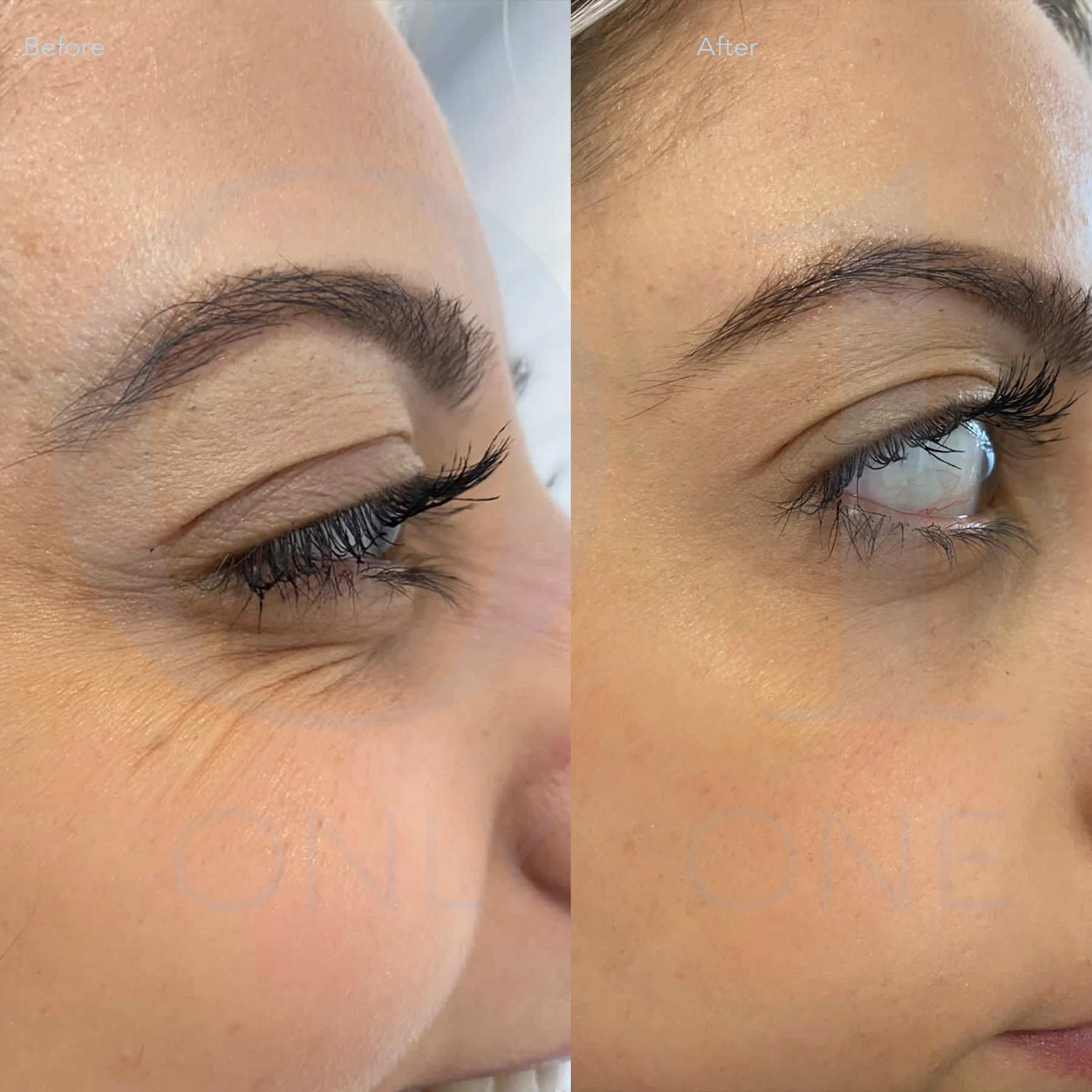 Wrinkle prevention treat to reduce crows feet
